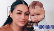 Permalink to Ibu Laser Wajah Bayinya Untuk Hilangkan Tanda Lahir